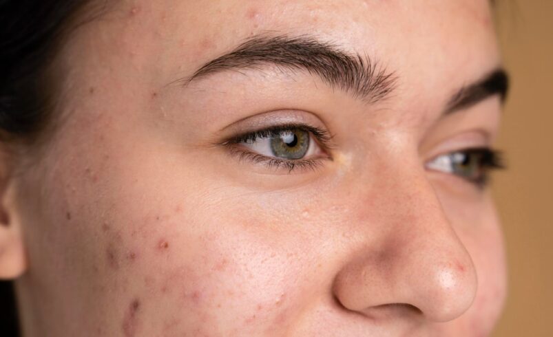 Her Yaşta Ortaya Çıkabilen Hormonal Akneyle Nasıl Baş Edilir?